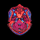MRI Brain Scan of Deformed Brainstem