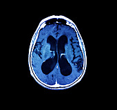 MRI of hydrocephalus