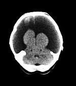 CT Image of Hydranencephaly