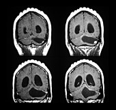 MRI of Cerebellar Hemangioblastoma
