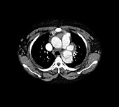 Aortic Dissection