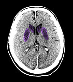 Brain of a Cardiac Arrest Victim