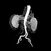 Abdominal Aorta and Kidneys