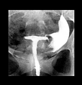 T-Shaped Uterus