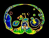 False-colour CT scan showing large kidney stone