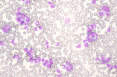 Leukemia