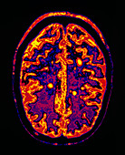 MRI scan of brain in multiple sclerosis (MS)