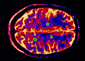 Col MRI brain scan of a multiple sclerosis patient