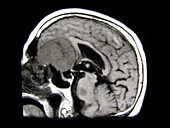 Large Olfactory Groove Meningioma