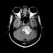 MRI of Acute MS