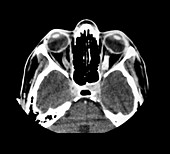 CT of Optic Meningioma