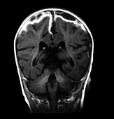 MRI of Meningitis