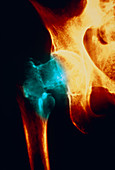 Coloured X-ray: femur fracture due to osteoporosis
