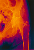 Osteoporosis X-ray