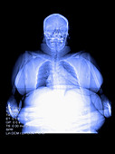 colour Enhanced Digital X-ray of Obesity