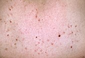 Pityriasis lichenoides spots on skin