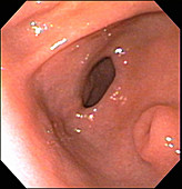 Ectopic Pancreas