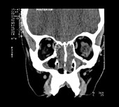 CT of Sinuses