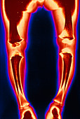 Coloured X-ray of healing rickets