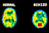 PET scans normal and schizophrenic brains