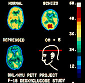 Schizophrenic and depressed brains