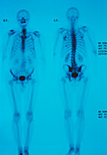 Sacroiliitis inflammation