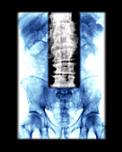 Lumbar Spine with Degenerative Changes