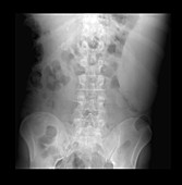 X-ray of abdomen showing enlarged spleen