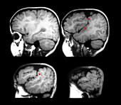 MRI Showing Schizencephaly