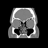 CT of Haller Air Cells on Sinus CT