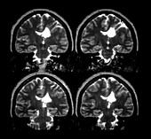 MRI Showing Schizencephaly