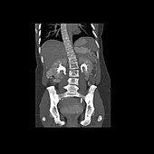 Thoracolumbar Scoliosis