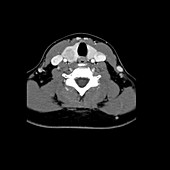 CT of neck showing thyroid nodule