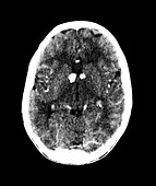 CT of Tuberous Sclerosis