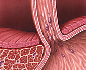 Esophageal Varices