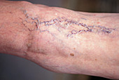 Varicose Veins