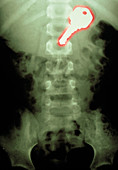 Swallowed key,X-ray