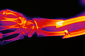 Coloured X-ray of fracture of the ulna & radius