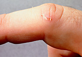 Close-up of a small cut healing on a finger