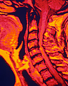 Coloured MRI scan of spinal cord injury to neck