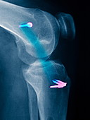Knee injury,X-ray