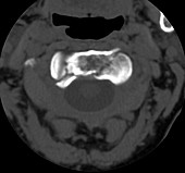 Severe Fracture of the Cervical Vertebrae