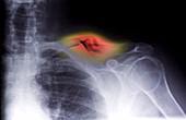 Comminuted Fracture of the Clavicle