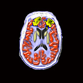 Post traumatic injury to frontal lobes