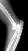 Lateral X-Ray of the Elbow