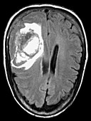 MRI of Head Injury