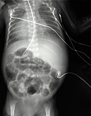X-ray of Swollen Abdomen