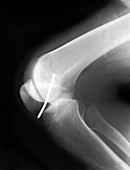 Knee X-Ray