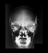 X-Ray of Skull Fracture