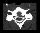 CT of Herniated Intervertebral Disc